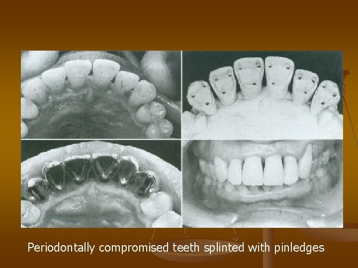 Periodontally compromised teeth splinted with pinledges 