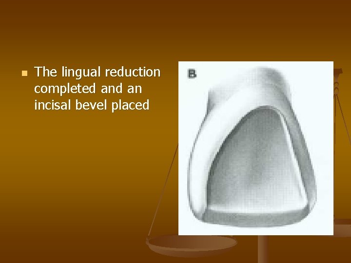 n The lingual reduction completed an incisal bevel placed 