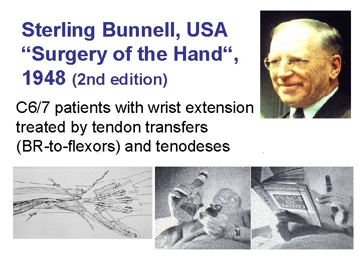 Sterling Bunnell, USA “Surgery of the Hand“, 1948 (2 nd edition) C 6/7 patients