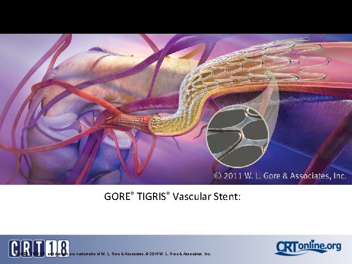 GORE® TIGRIS® Vascular Stent: GORE®, TIGRIS®, and designs are trademarks of W. L. Gore GORE® TIGRIS® Vascular Stent: GORE®, TIGRIS®, and designs are trademarks of W. L. Gore