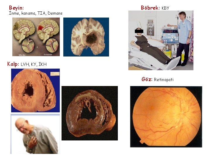 Beyin: İnme, kanama, TIA, Demans Kalp: Böbrek: KBY LVH, KY, İKH Göz: Retinopati 