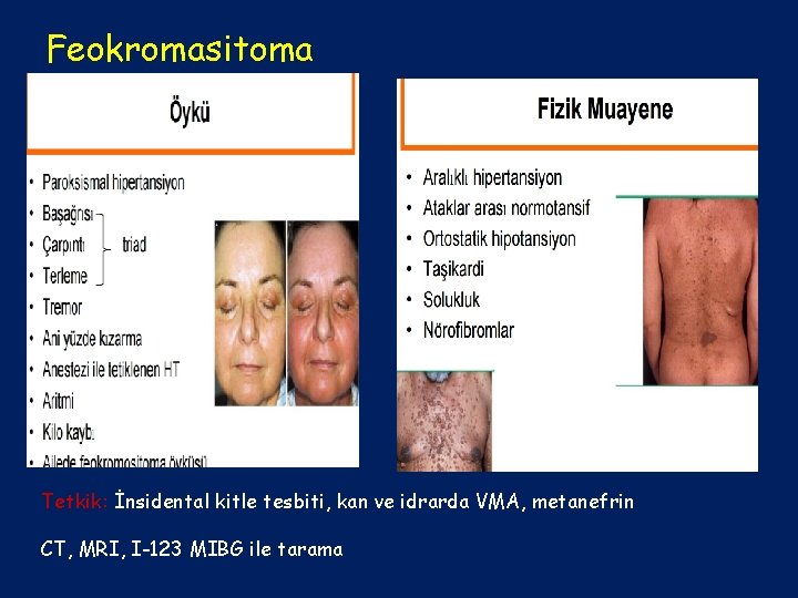Feokromasitoma Tetkik: İnsidental kitle tesbiti, kan ve idrarda VMA, metanefrin CT, MRI, I-123 MIBG