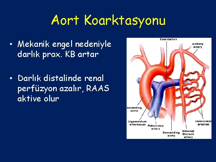 Aort Koarktasyonu • Mekanik engel nedeniyle darlık prox. KB artar • Darlık distalinde renal