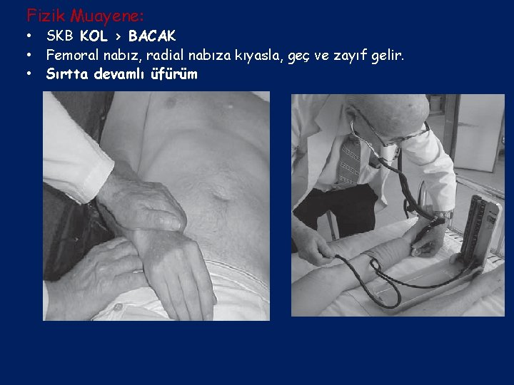 Fizik Muayene: • SKB KOL > BACAK • Femoral nabız, radial nabıza kıyasla, geç