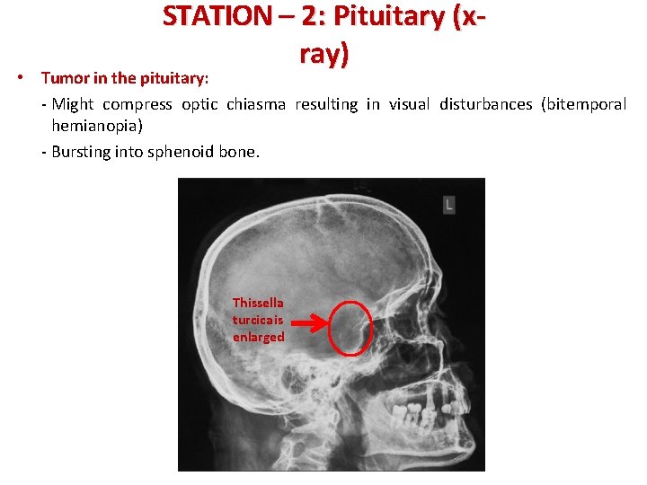 STATION – 2: Pituitary (xray) • Tumor in the pituitary: - Might compress optic