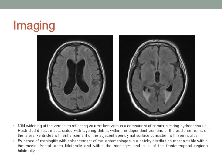 Imaging • Mild widening of the ventricles reflecting volume loss versus a component of