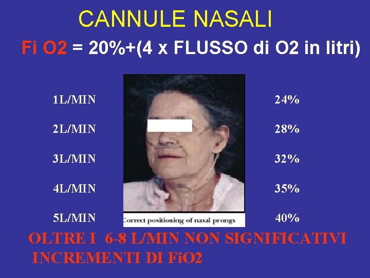 CANNULE NASALI Fi O 2 = 20%+(4 x FLUSSO di O 2 in litri)