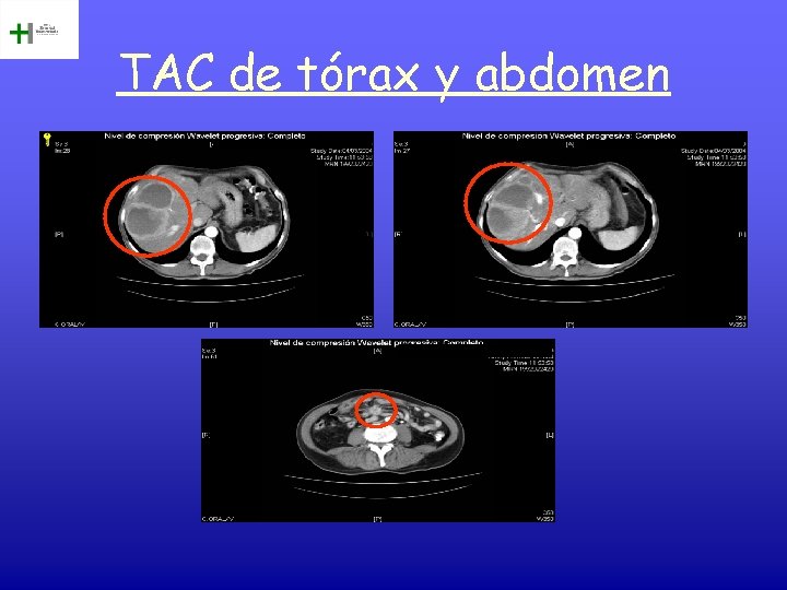 TAC de tórax y abdomen 