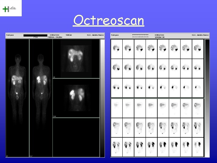 Octreoscan 