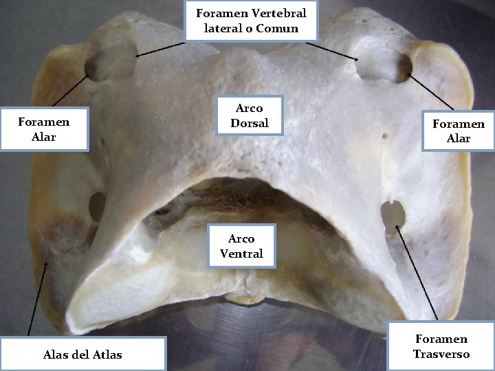 Foramen Vertebral lateral o Comun Foramen Alar Arco Dorsal Foramen Alar Arco Ventral Alas Foramen Vertebral lateral o Comun Foramen Alar Arco Dorsal Foramen Alar Arco Ventral Alas