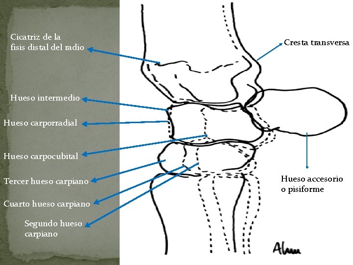 Cicatriz de la fisis distal del radio Cresta transversa Hueso intermedio Hueso carporradial Hueso