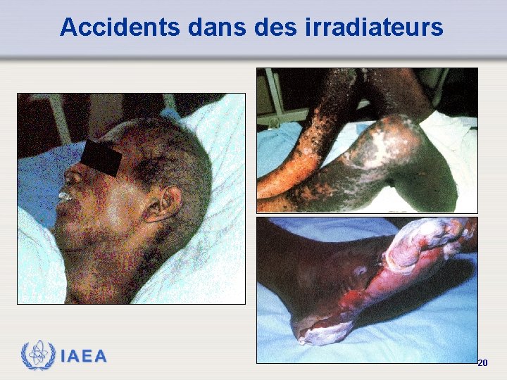 Accidents dans des irradiateurs IAEA 20 