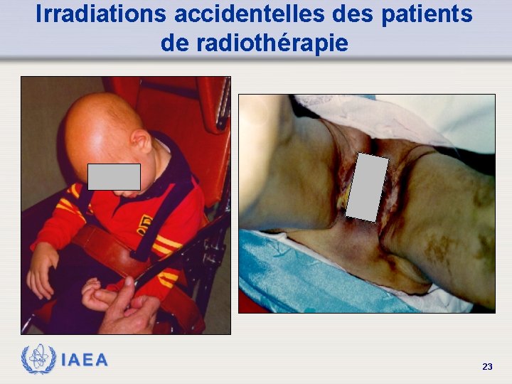 Irradiations accidentelles des patients de radiothérapie IAEA 23 