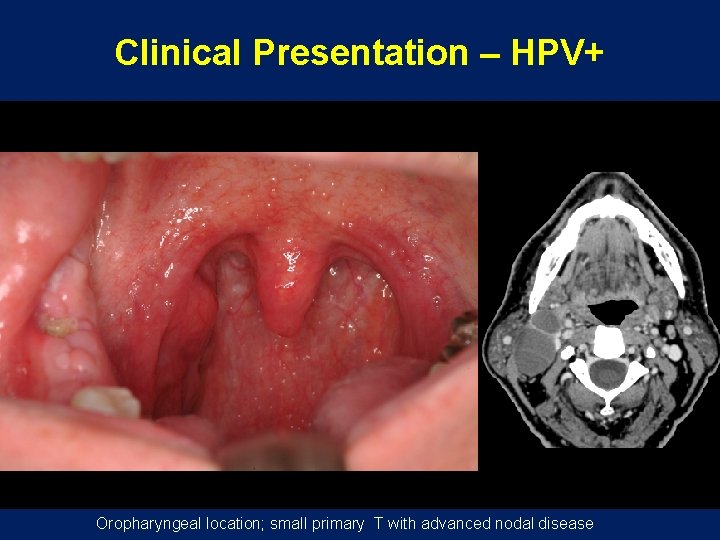 Clinical Presentation – HPV+ Oropharyngeal location; small primary T with advanced nodal disease 