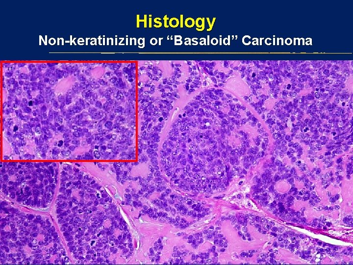 Histology Non-keratinizing or “Basaloid” Carcinoma 