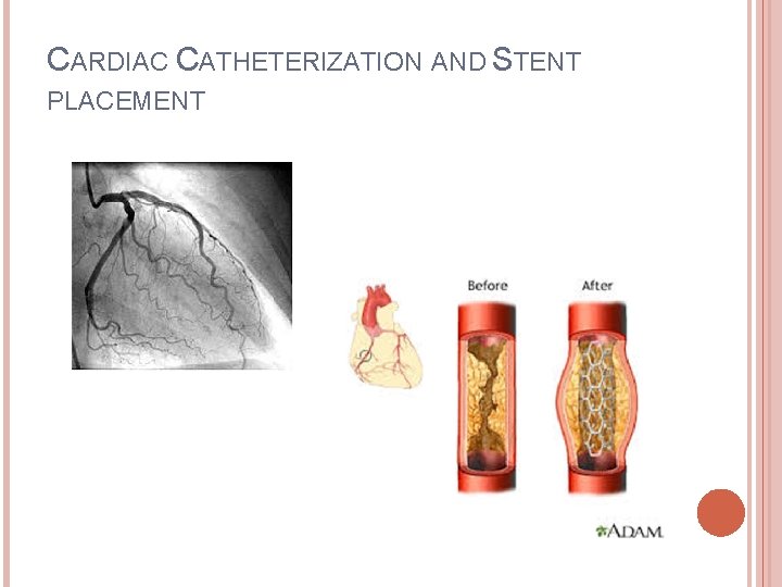 CARDIAC CATHETERIZATION AND STENT PLACEMENT 