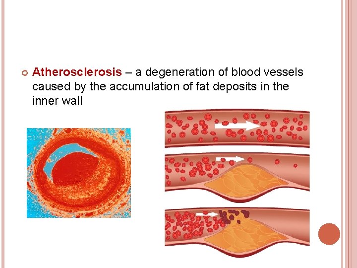  Atherosclerosis – a degeneration of blood vessels caused by the accumulation of fat