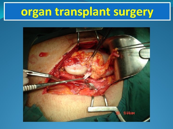 organ transplant surgery 