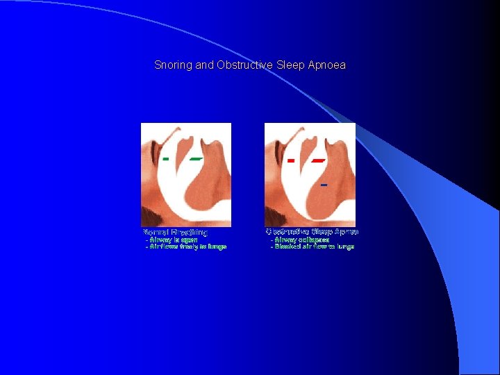 Snoring and Obstructive Sleep Apnoea Snoring and Obstructive Sleep Apnoea