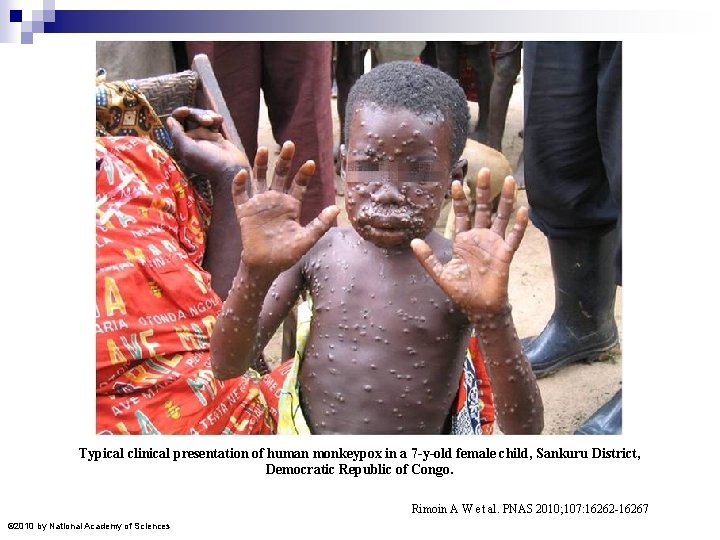 Typical clinical presentation of human monkeypox in a 7 -y-old female child, Sankuru District,