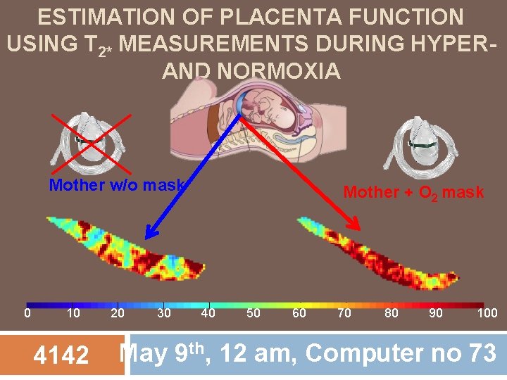 ESTIMATION OF PLACENTA FUNCTION USING T 2* MEASUREMENTS DURING HYPERAND NORMOXIA Mother w/o mask ESTIMATION OF PLACENTA FUNCTION USING T 2* MEASUREMENTS DURING HYPERAND NORMOXIA Mother w/o mask