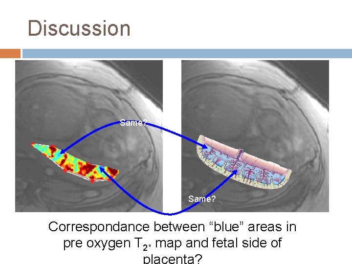 Discussion Same? Correspondance between “blue” areas in pre oxygen T 2* map and fetal Discussion Same? Correspondance between “blue” areas in pre oxygen T 2* map and fetal