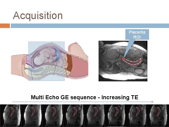 Acquisition Placenta ROI Multi Echo GE sequence - Increasing TE Acquisition Placenta ROI Multi Echo GE sequence - Increasing TE