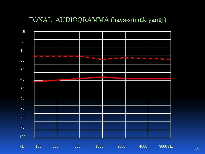 TONAL AUDIOQRAMMA (hava-sümük yarığı) -10 0 10 20 30 40 50 60 70 80