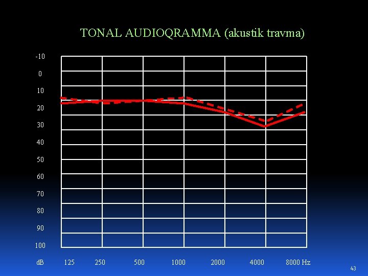 TONAL AUDIOQRAMMA (akustik travma) -10 0 10 20 30 40 50 60 70 80