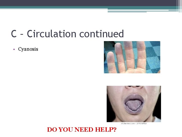 C – Circulation continued • Cyanosis DO YOU NEED HELP? 