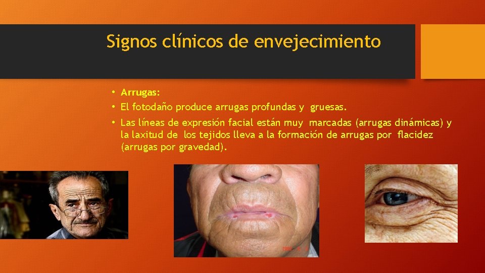 Signos clínicos de envejecimiento • Arrugas: • El fotodaño produce arrugas profundas y gruesas.