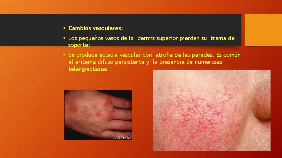  • Cambios vasculares: • Los pequeños vasos de la dermis superior pierden su