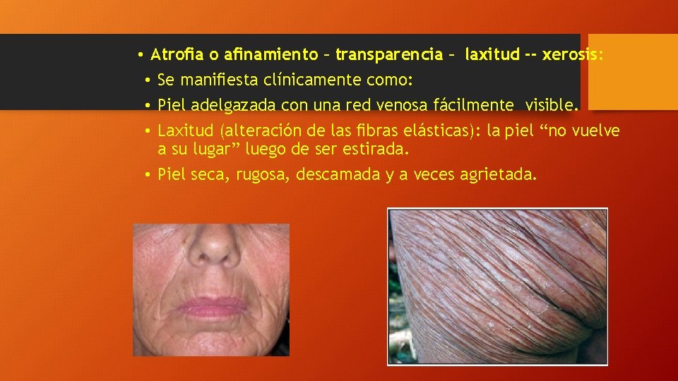  • Atroﬁa o aﬁnamiento – transparencia – laxitud - xerosis: • Se maniﬁesta