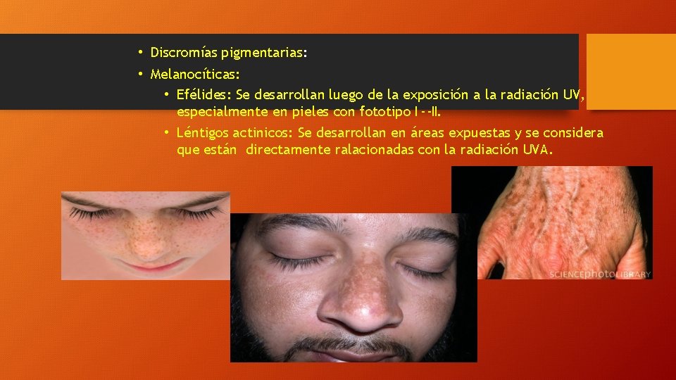  • Discromías pigmentarias: • Melanocíticas: • Efélides: Se desarrollan luego de la exposición