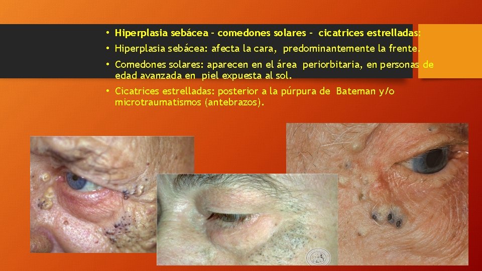  • Hiperplasia sebácea – comedones solares – cicatrices estrelladas: • Hiperplasia sebácea: afecta