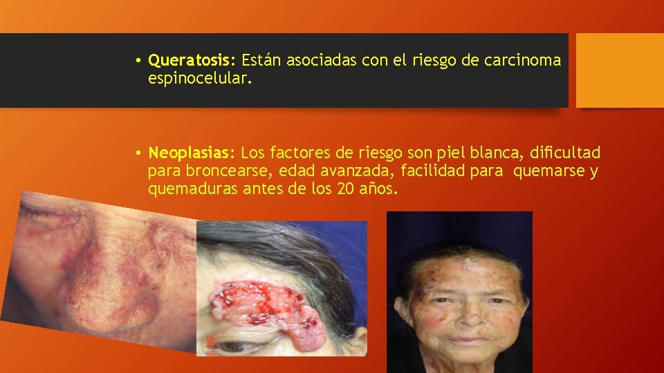  • Queratosis: Están asociadas con el riesgo de carcinoma espinocelular. • Neoplasias: Los