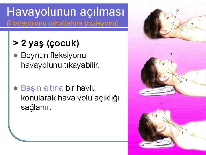 Havayolunun açılması (Havayolunu rahatlatma pozisyonu) > 2 yaş (çocuk) l Boynun fleksiyonu havayolunu tıkayabilir.