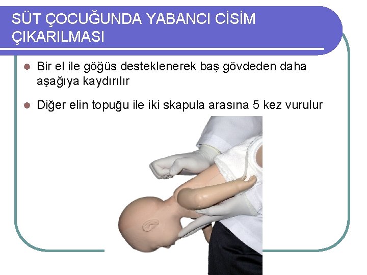 SÜT ÇOCUĞUNDA YABANCI CİSİM ÇIKARILMASI l Bir el ile göğüs desteklenerek baş gövdeden daha