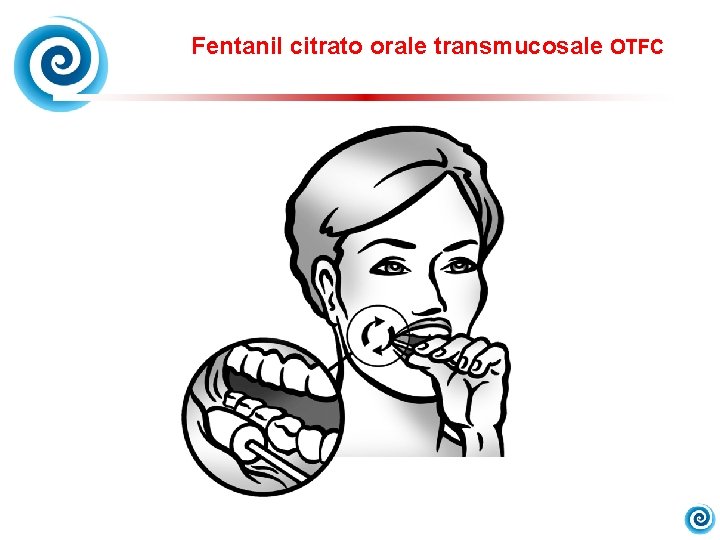 Fentanil citrato orale transmucosale OTFC 