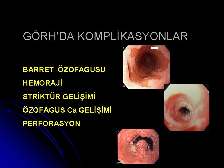 GÖRH’DA KOMPLİKASYONLAR BARRET ÖZOFAGUSU HEMORAJİ STRİKTÜR GELİŞİMİ ÖZOFAGUS Ca GELİŞİMİ PERFORASYON 