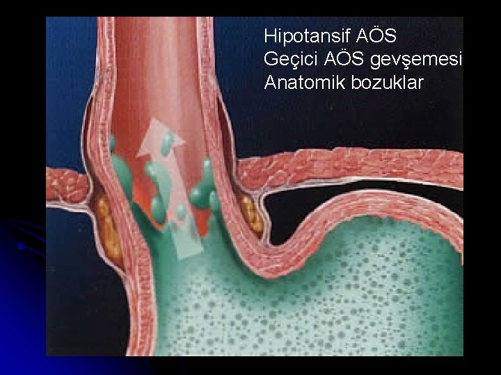 Hipotansif AÖS Geçici AÖS gevşemesi Anatomik bozuklar 