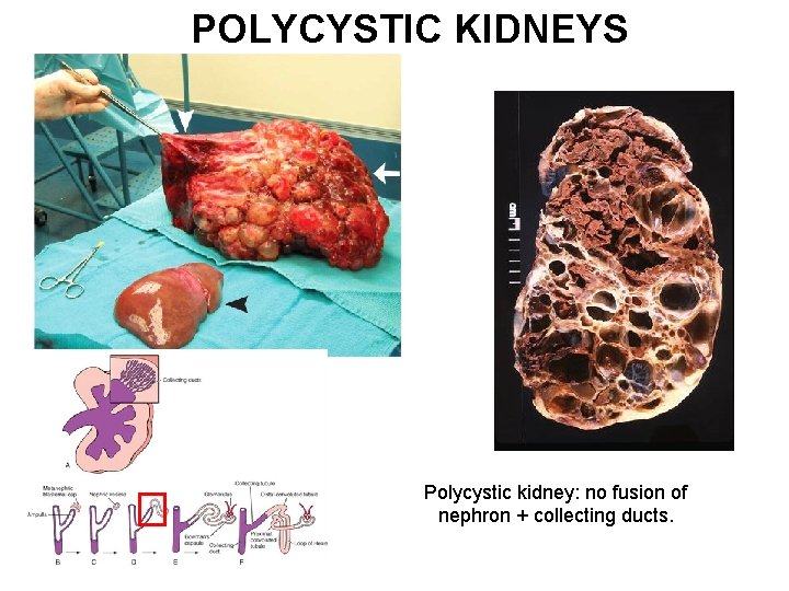 POLYCYSTIC KIDNEYS Polycystic kidney: no fusion of nephron + collecting ducts. POLYCYSTIC KIDNEYS Polycystic kidney: no fusion of nephron + collecting ducts.