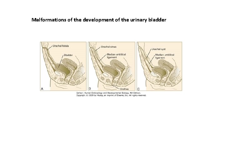 Malformations of the development of the urinary bladder Malformations of the development of the urinary bladder