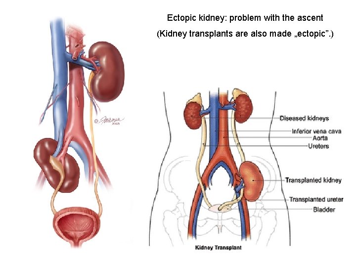 Ectopic kidney: problem with the ascent (Kidney transplants are also made „ectopic”. ) Ectopic kidney: problem with the ascent (Kidney transplants are also made „ectopic”. )