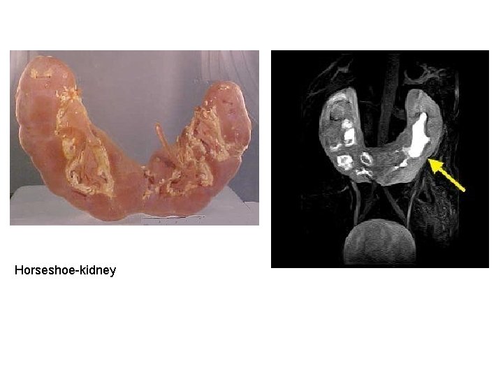 Horseshoe-kidney Horseshoe-kidney