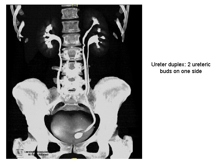 Ureter duplex: 2 ureteric buds on one side Ureter duplex: 2 ureteric buds on one side