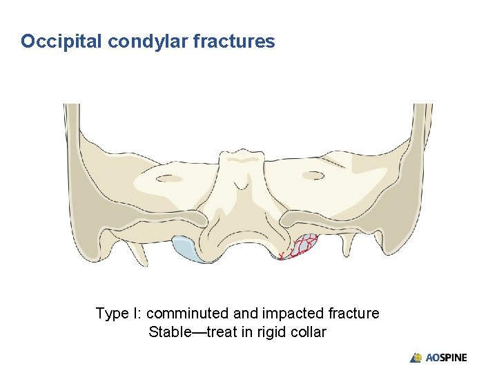 Occipital condylar fractures Type I: comminuted and impacted fracture Stable—treat in rigid collar Occipital condylar fractures Type I: comminuted and impacted fracture Stable—treat in rigid collar