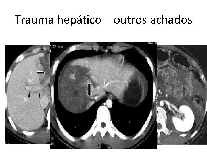 Trauma hepático – outros achados 