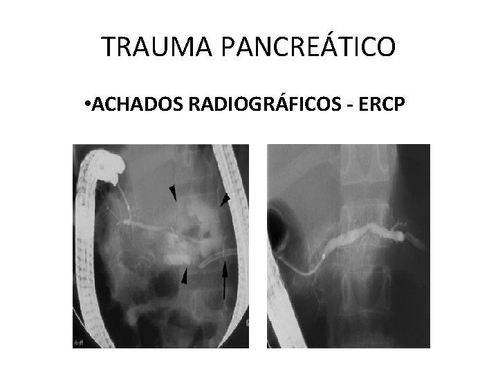 TRAUMA PANCREÁTICO • ACHADOS RADIOGRÁFICOS - ERCP 
