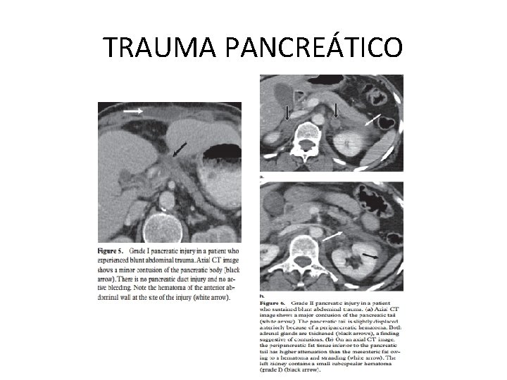 TRAUMA PANCREÁTICO 